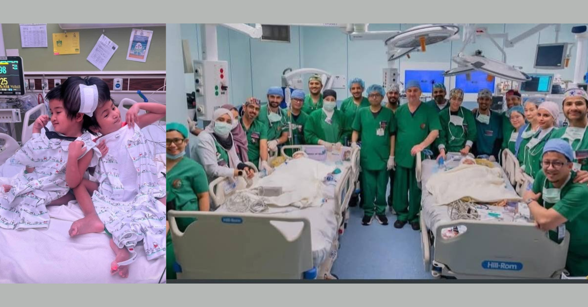 Filipino conjoined twins separated in Riyadh — Complex surgery succeeds